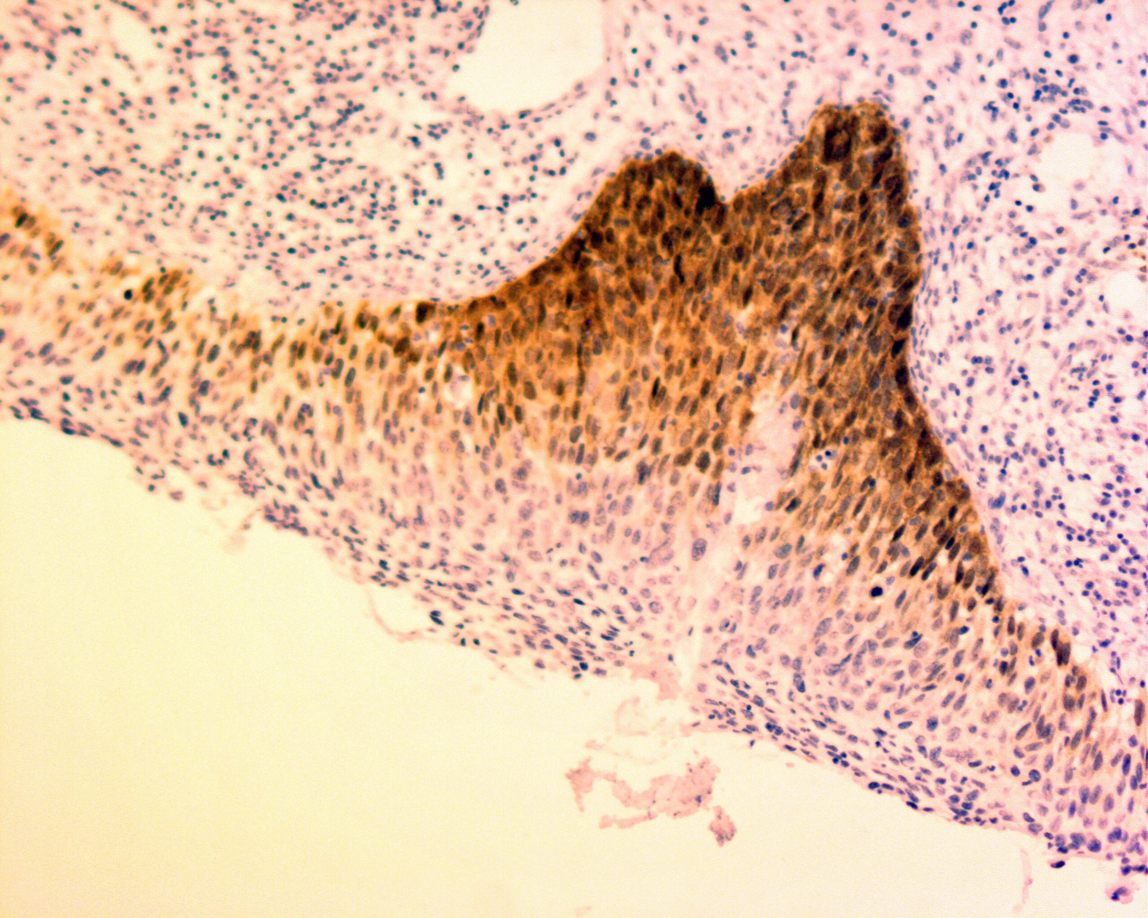 Figure 2. Immunohistochemical staining of formalin fixed, paraffin embedded  tissue from an HPV infected preneoplastic lesion in the uterine cervix using p16-INK4a antibody (Cat. No. C170M). Antigen retreival was performed with Tris/EDTA buffer pH 9.